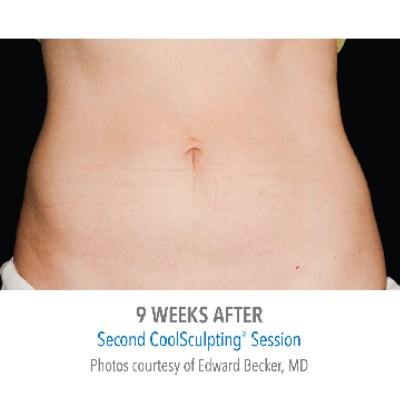 After PHDermatology CoolSculpting®