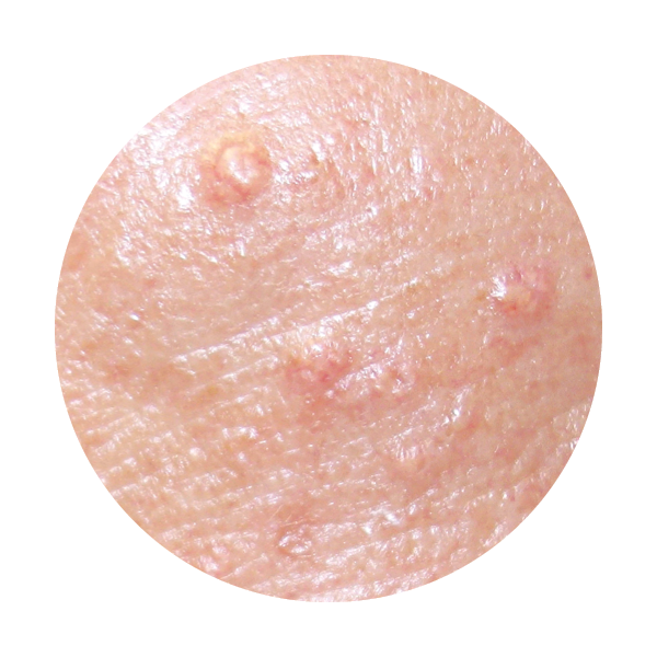 CellFX Skin Lesion Bumps