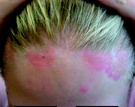 Xtrac Psoriasis before scalp