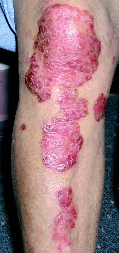 Xtrac Psoriasis before
